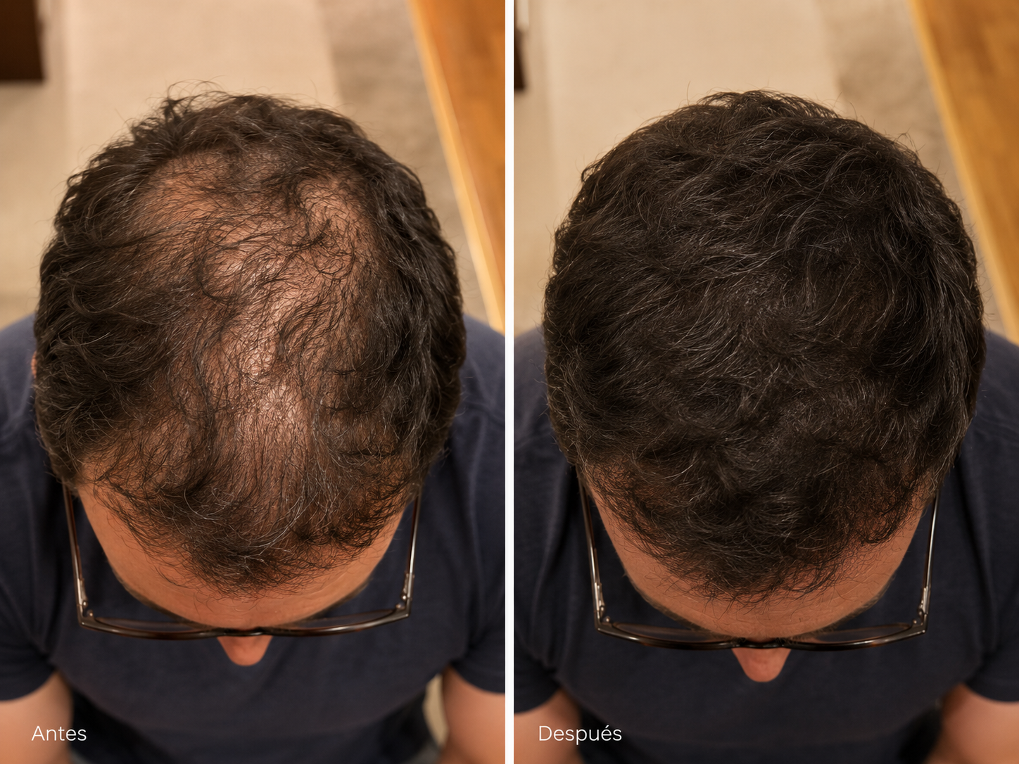 Inicio Folinove Comparativa cosmética antes y después de la rutina Folinove tras un uso continuado